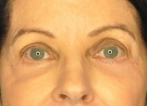 Dr. Wirth Eyelid Surgery Before & After Photo in Newport Beach