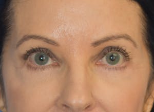 Dr. Wirth Eyelid Surgery Before & After Photo in Newport Beach