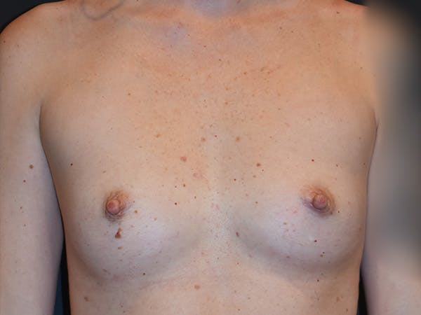 Breast Augmentation Before & After Gallery - Patient 426687 - Image 1