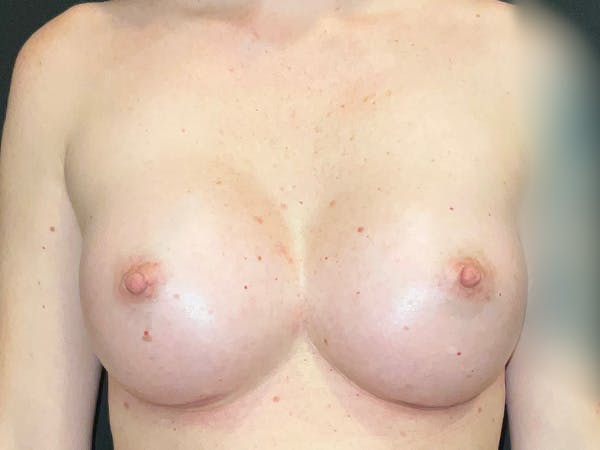 Breast Augmentation Before & After Gallery - Patient 426687 - Image 2