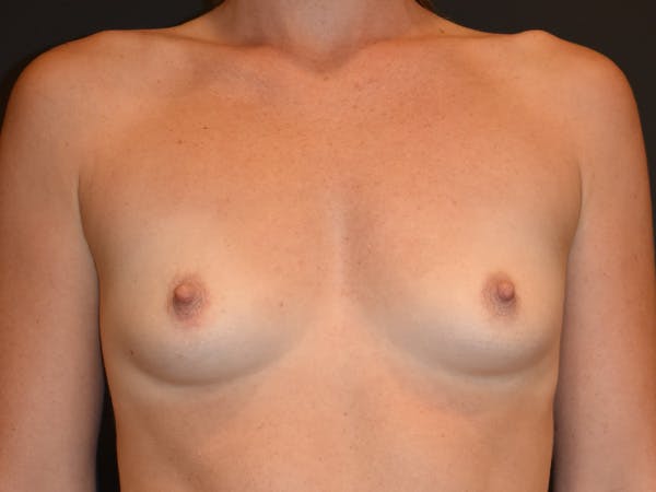 Breast Augmentation Before & After Gallery - Patient 533913 - Image 1