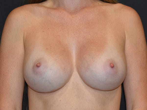 Breast Augmentation Before & After Gallery - Patient 533913 - Image 2