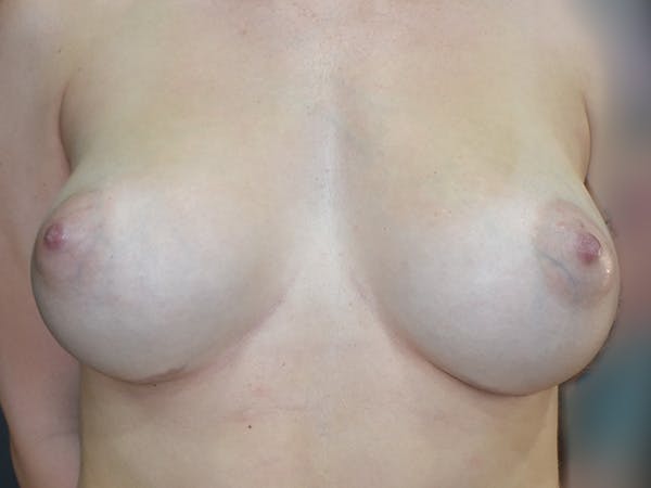 Breast Augmentation Before & After Gallery - Patient 236873 - Image 4