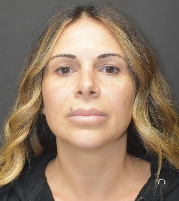 Neck Liposuction Before & After Gallery - Patient 313648 - Image 1