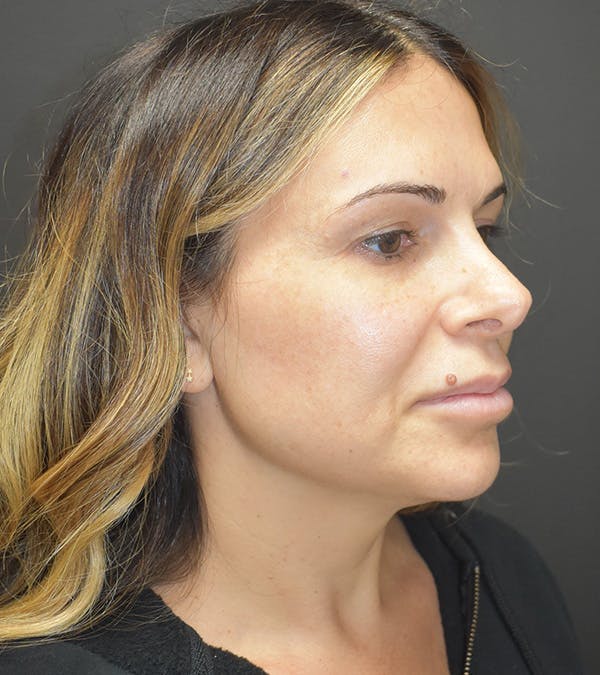 Neck Liposuction Before & After Gallery - Patient 313648 - Image 3