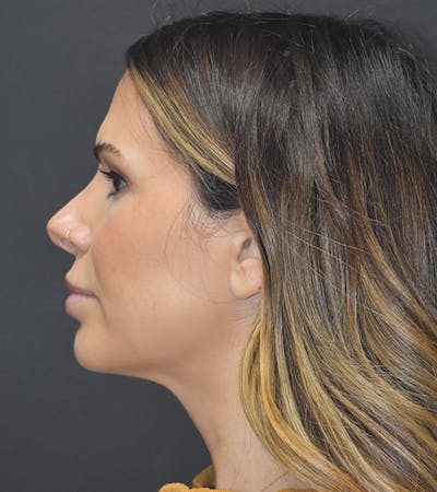 Neck Liposuction Before & After Gallery - Patient 313648 - Image 10
