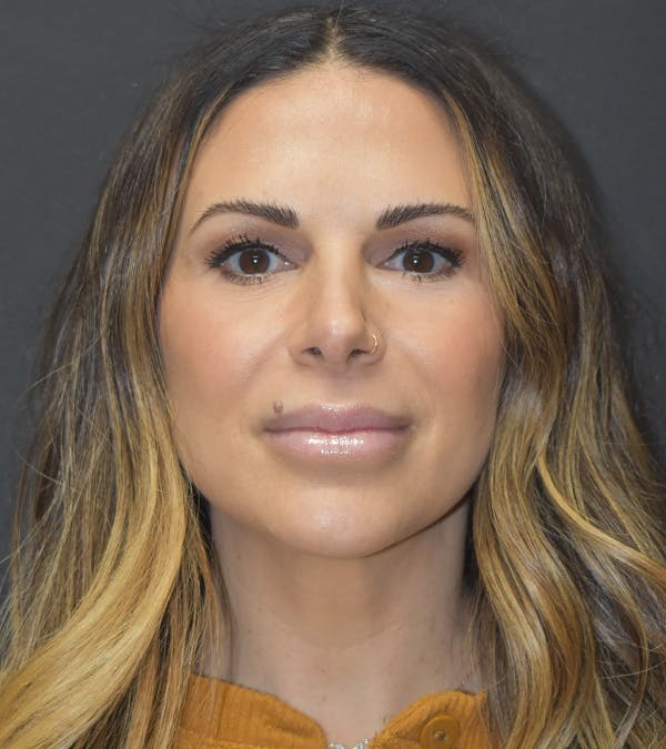 Neck Liposuction Before & After Gallery - Patient 313648 - Image 2