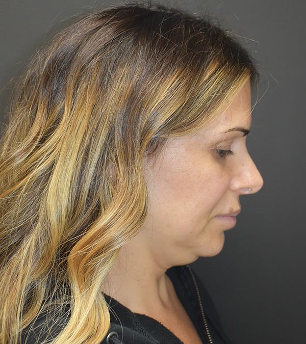 Neck Liposuction Before & After Gallery - Patient 313648 - Image 5