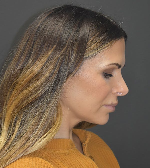 Neck Liposuction Before & After Gallery - Patient 313648 - Image 6