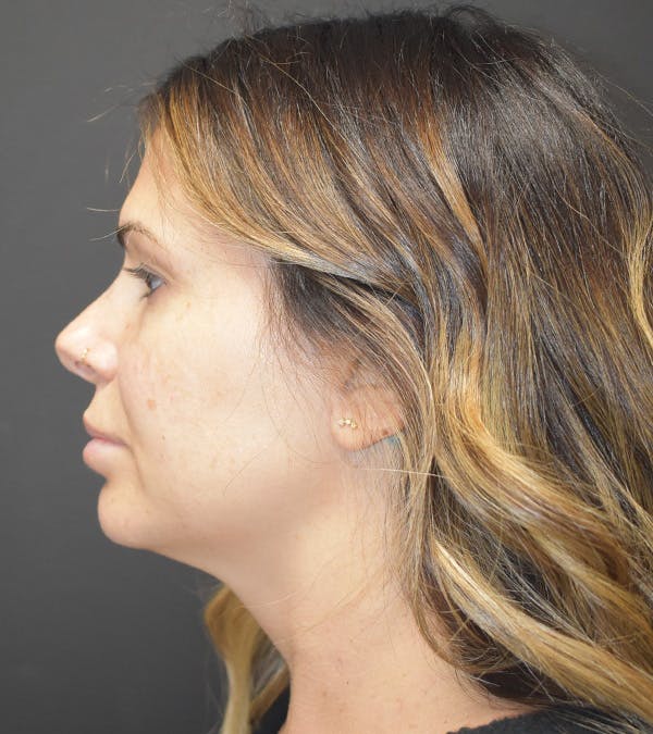 Neck Liposuction Before & After Gallery - Patient 313648 - Image 9