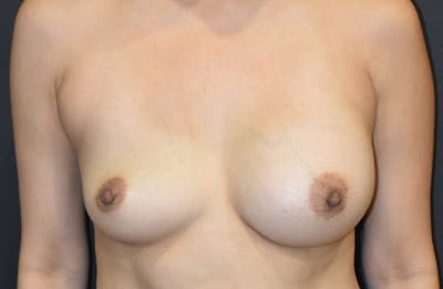 Breast Revision Before & After Gallery - Patient 114011 - Image 1