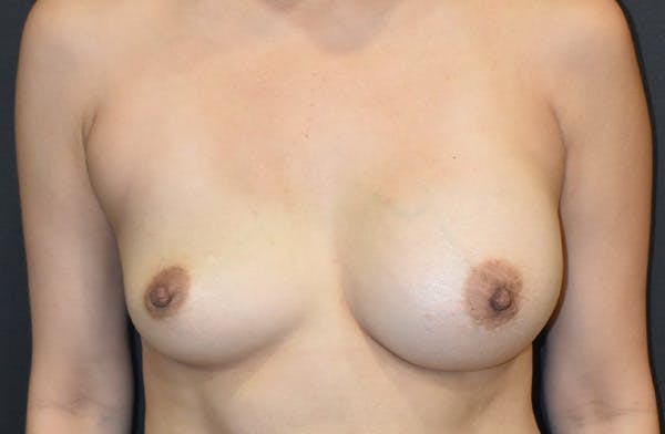 Breast Revision Before & After Gallery - Patient 114011 - Image 1