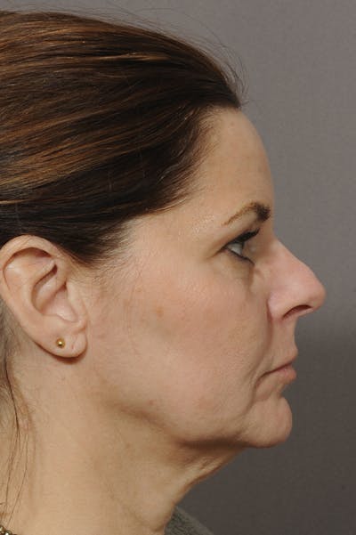 Facelift Before & After Gallery - Patient 18726358 - Image 1