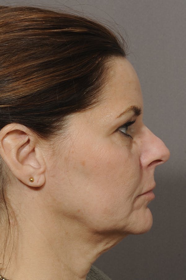 Facelift Before & After Gallery - Patient 18726358 - Image 3