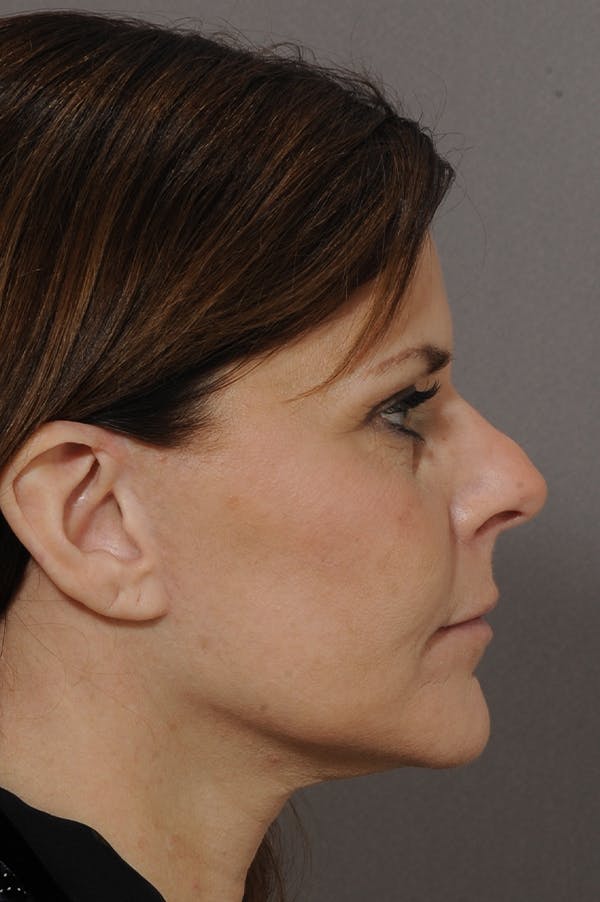 Facelift Before & After Gallery - Patient 18726358 - Image 4