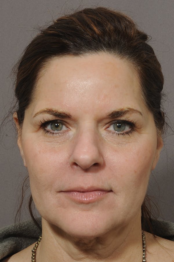 Facelift Before & After Gallery - Patient 18726358 - Image 5