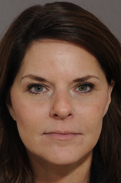 Facelift Before & After Gallery - Patient 18726358 - Image 6