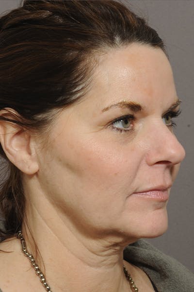 Facelift Before & After Gallery - Patient 18726358 - Image 1
