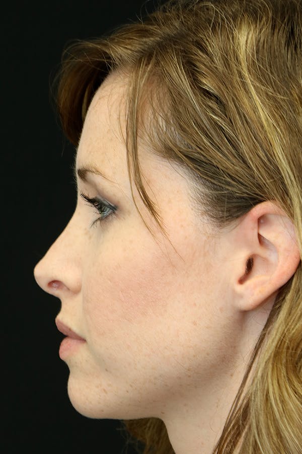Revision Rhinoplasty Before & After Gallery - Patient 18726371 - Image 1