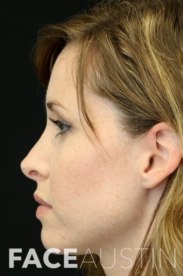 Revision Rhinoplasty Before & After Gallery - Patient 18726371 - Image 1