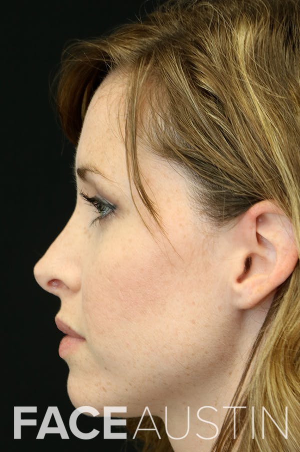 Revision Rhinoplasty Before & After Gallery - Patient 18726371 - Image 1