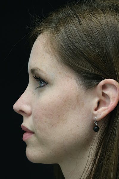 Revision Rhinoplasty Before & After Gallery - Patient 18726371 - Image 2