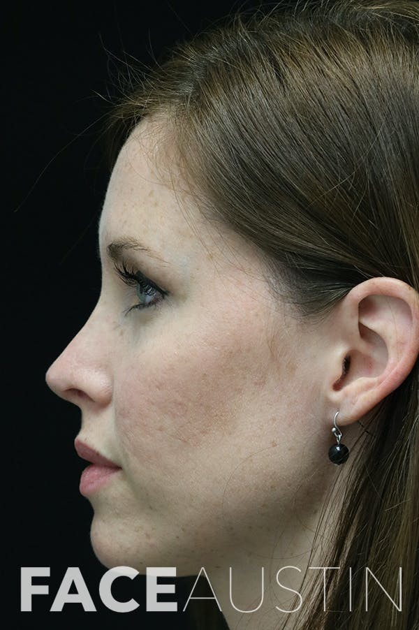 Revision Rhinoplasty Before & After Gallery - Patient 18726371 - Image 2