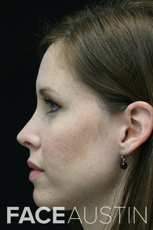 Revision Rhinoplasty Before & After Gallery - Patient 18726371 - Image 2