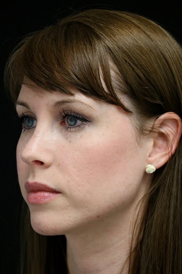 Revision Rhinoplasty Gallery - Patient 18726371 - Image 4