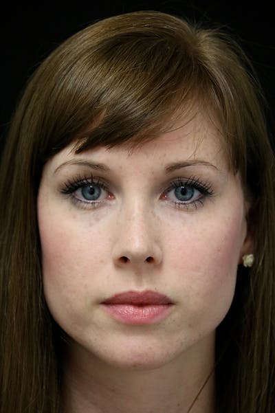 Revision Rhinoplasty Before & After Gallery - Patient 18726371 - Image 6