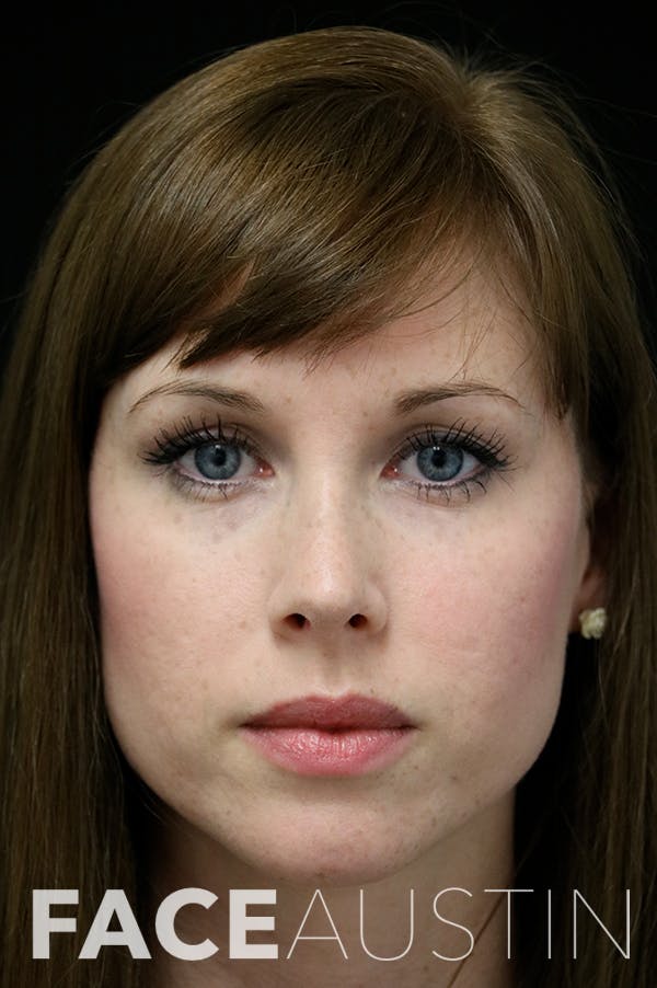 Revision Rhinoplasty Before & After Gallery - Patient 18726371 - Image 6