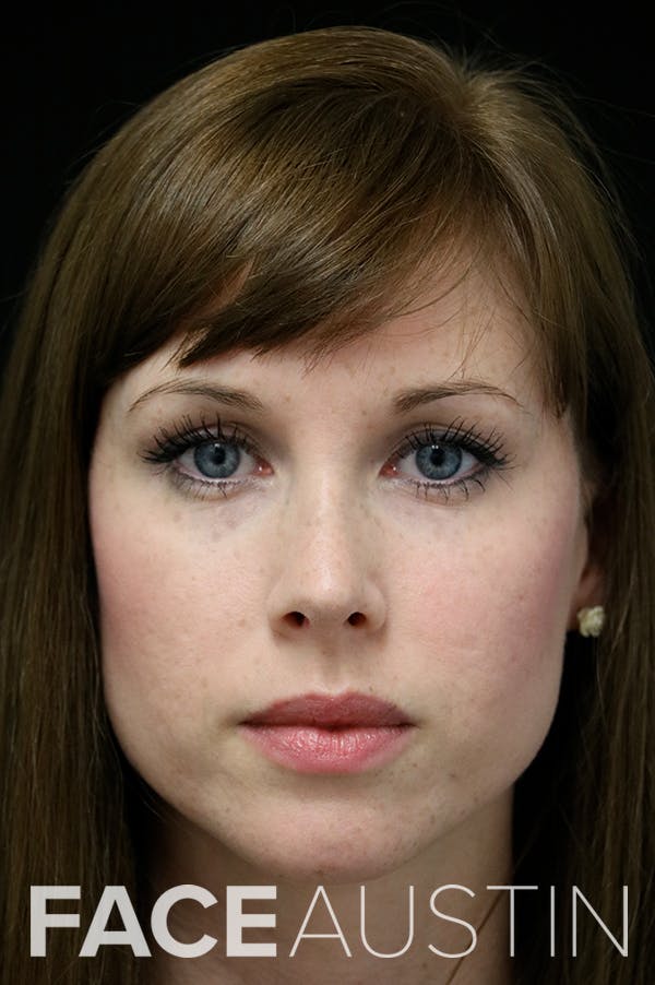 Revision Rhinoplasty Before & After Gallery - Patient 18726371 - Image 6