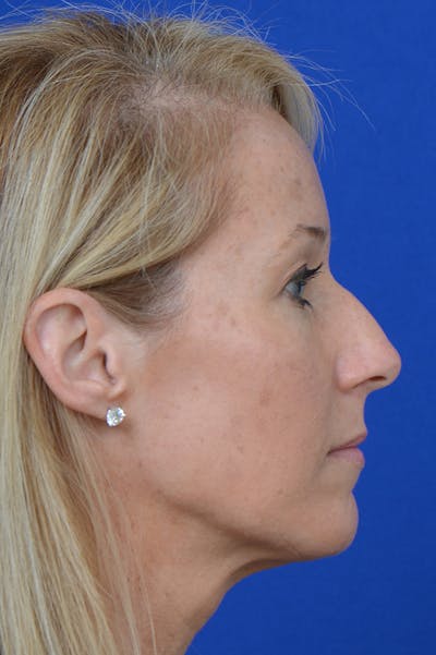 Rhinoplasty Before & After Gallery - Patient 18726389 - Image 1