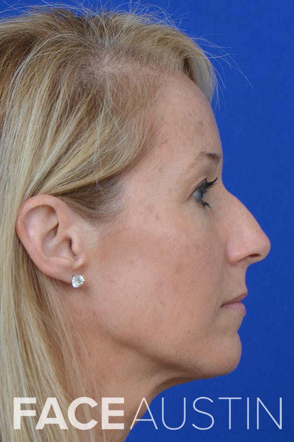 Rhinoplasty Before & After Gallery - Patient 18726389 - Image 1