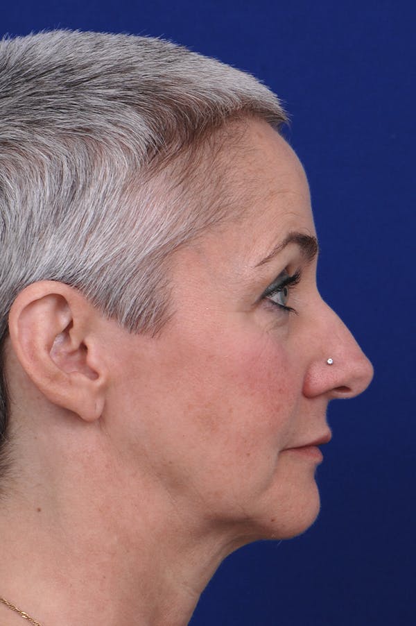 Rhinoplasty Before & After Gallery - Patient 18726390 - Image 3
