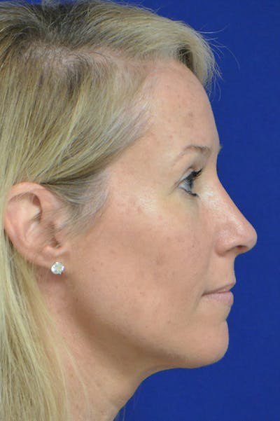 Rhinoplasty Before & After Gallery - Patient 18726389 - Image 4