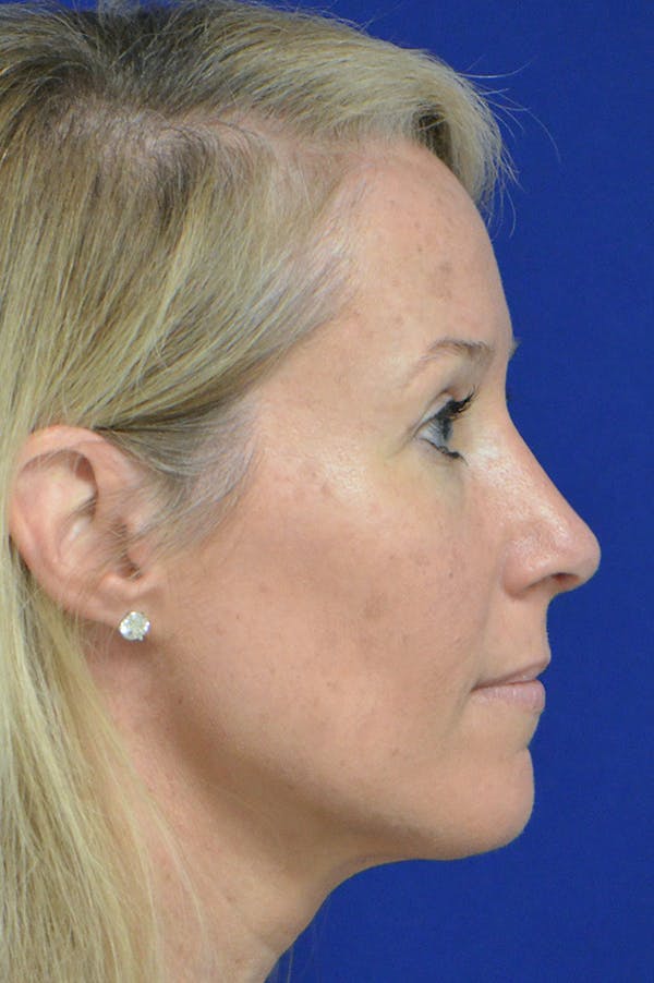 Rhinoplasty Before & After Gallery - Patient 18726389 - Image 2