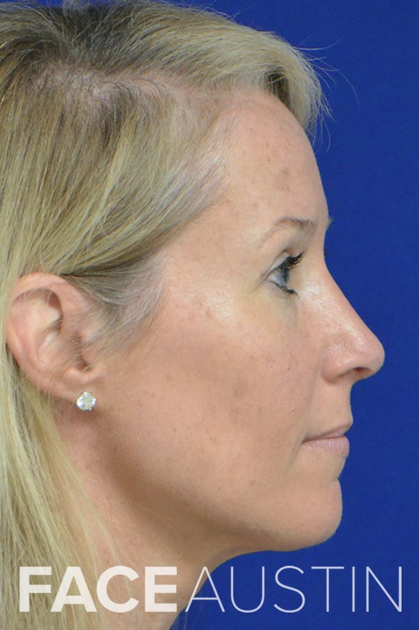 Rhinoplasty Before & After Gallery - Patient 18726389 - Image 4