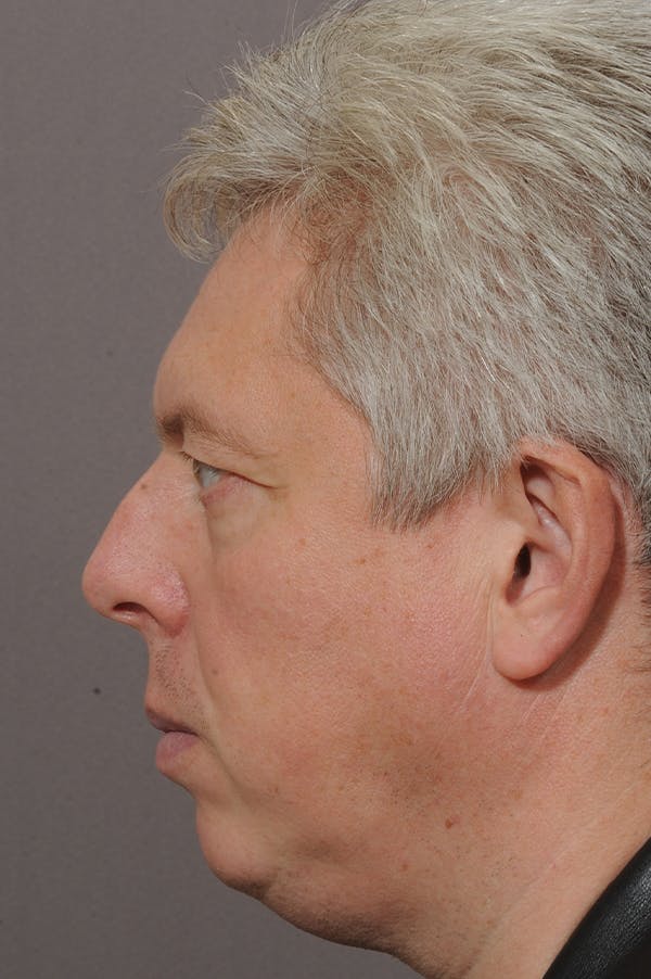 Rhinoplasty Before & After Gallery - Patient 18726391 - Image 3