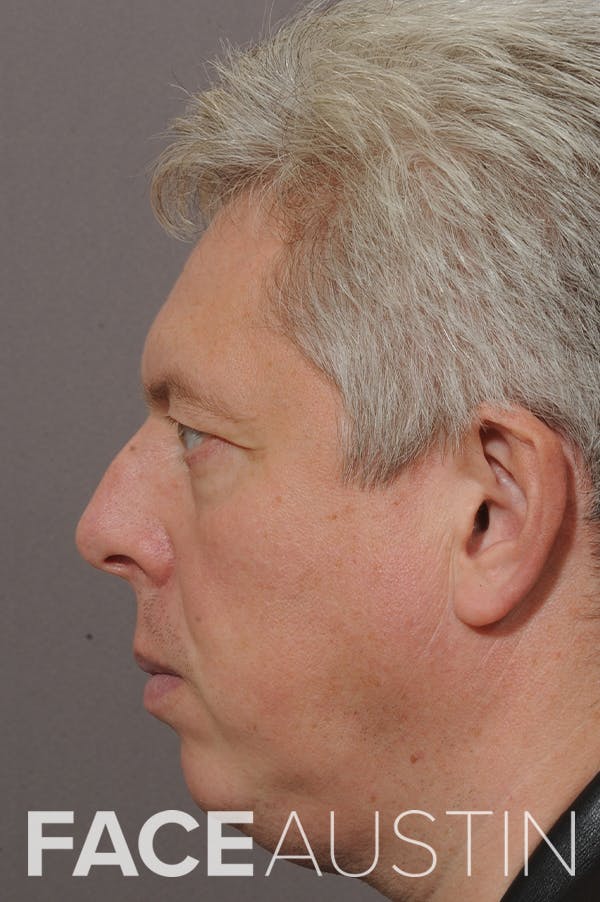 Rhinoplasty Before & After Gallery - Patient 18726391 - Image 1
