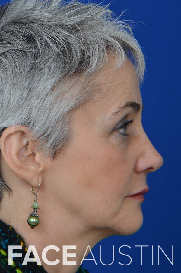 Rhinoplasty Before & After Gallery - Patient 18726390 - Image 4