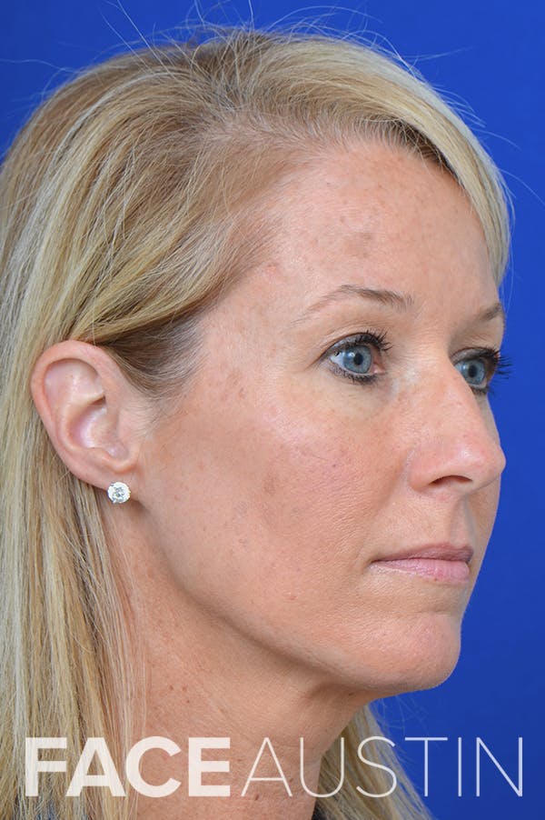 Rhinoplasty Before & After Gallery - Patient 18726389 - Image 1