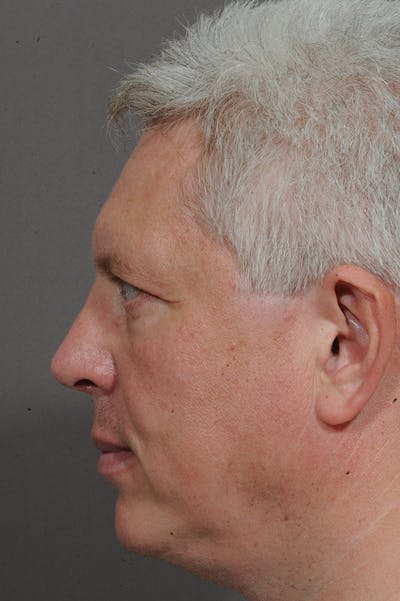 Rhinoplasty Before & After Gallery - Patient 18726391 - Image 2