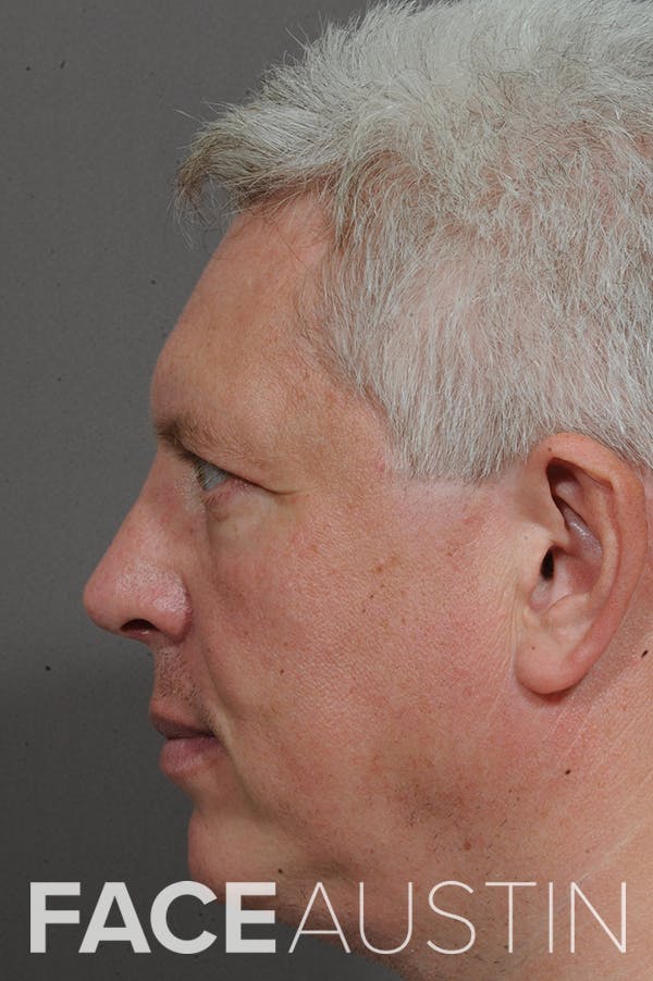 Rhinoplasty Before & After Gallery - Patient 18726391 - Image 4