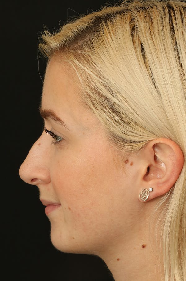 Rhinoplasty Before & After Gallery - Patient 18726392 - Image 3
