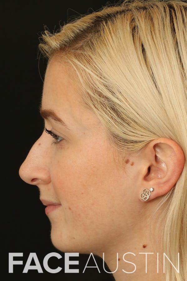 Rhinoplasty Before & After Gallery - Patient 18726392 - Image 1