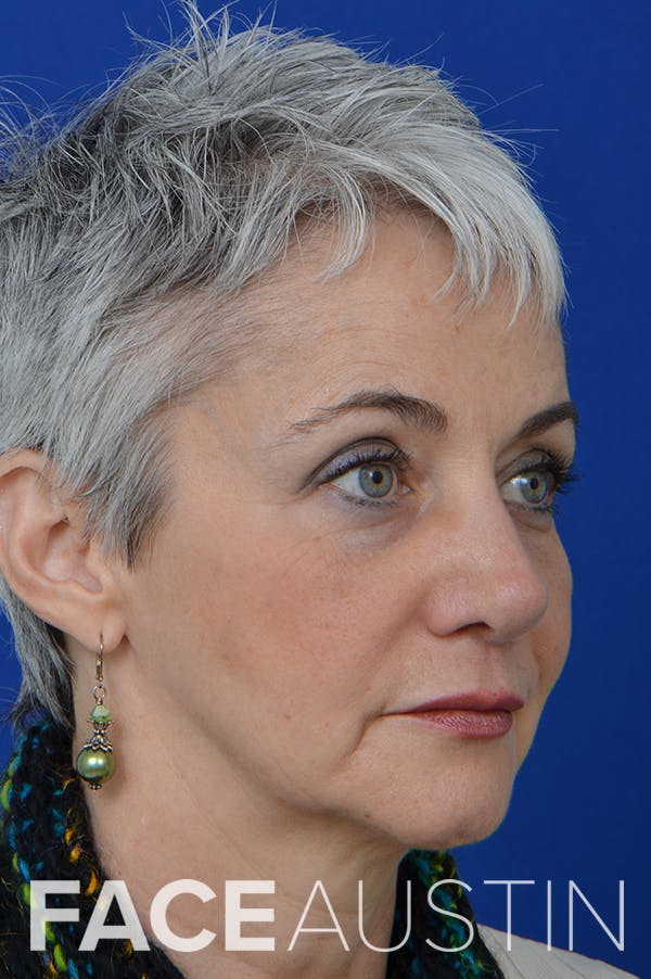 Rhinoplasty Before & After Gallery - Patient 18726390 - Image 2