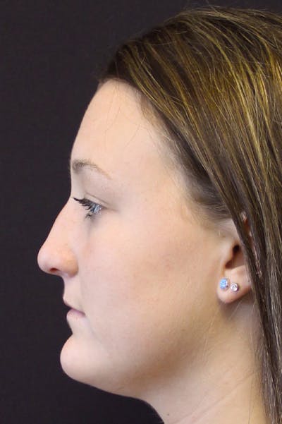 Rhinoplasty Before & After Gallery - Patient 18726393 - Image 1