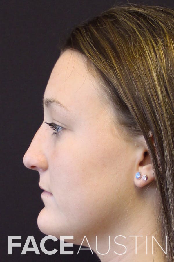 Rhinoplasty Before & After Gallery - Patient 18726393 - Image 1