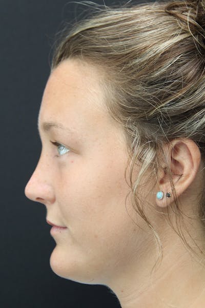 Rhinoplasty Before & After Gallery - Patient 18726393 - Image 4